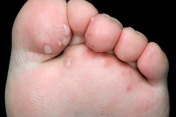 Bệnh tay chân miệng (Hand-Foot and Mouth Disease – HFMD)